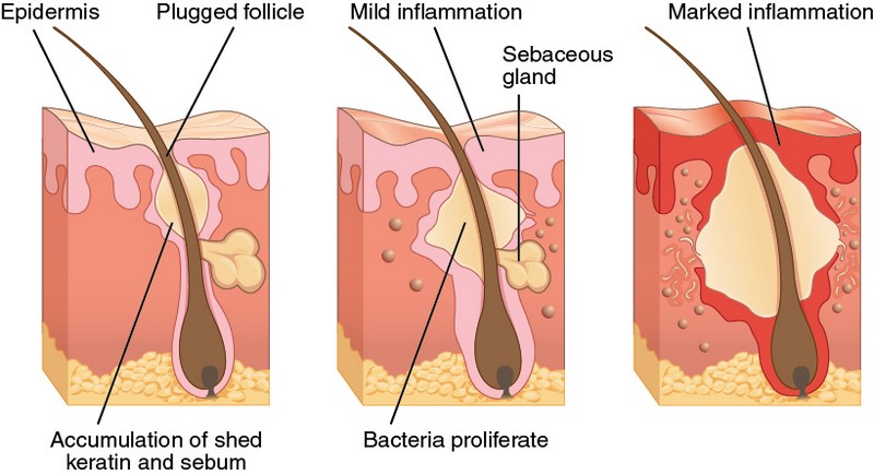 pimples are caused by inflammation of skin due to plugged follicle