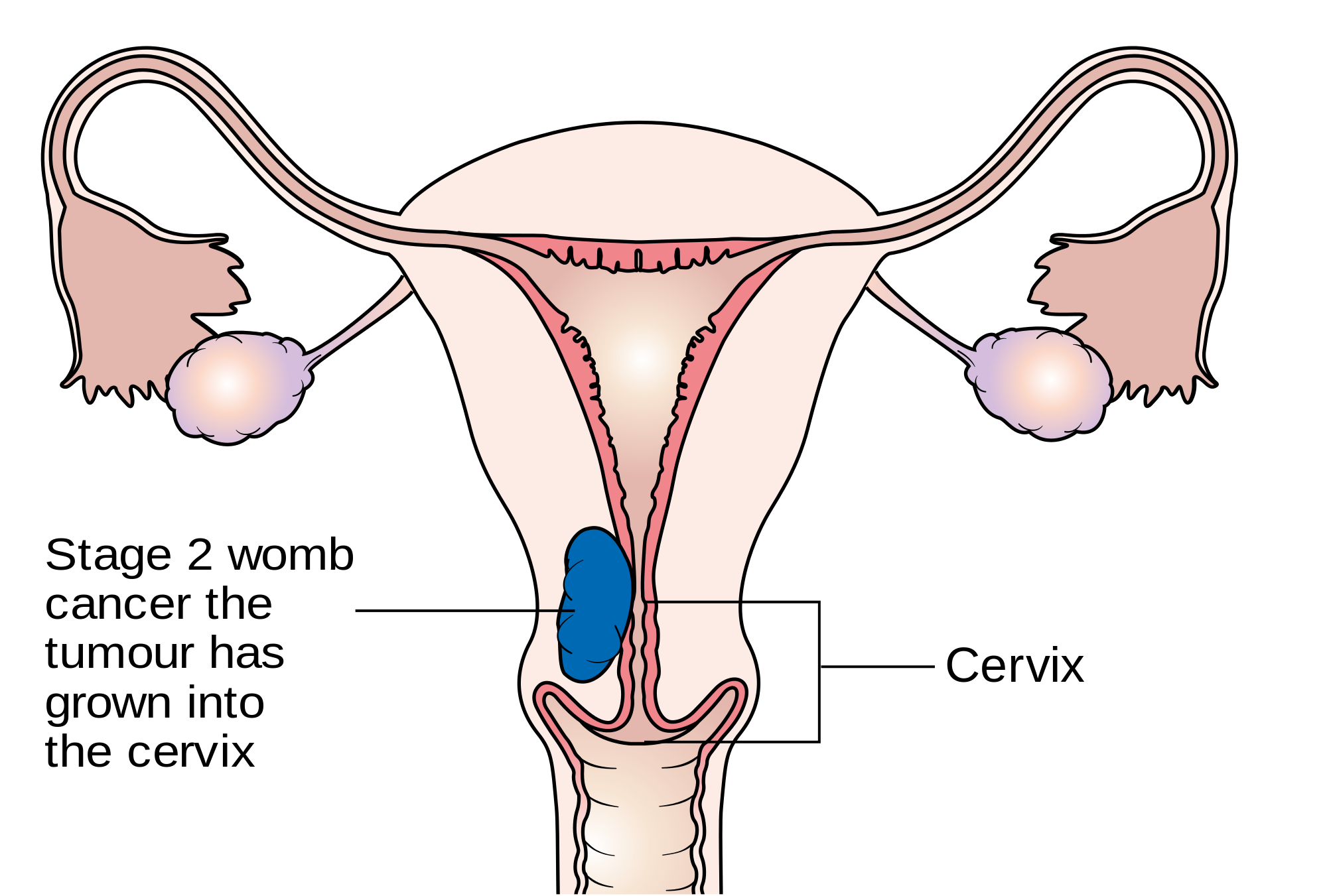 symptoms of Uterine Cancer