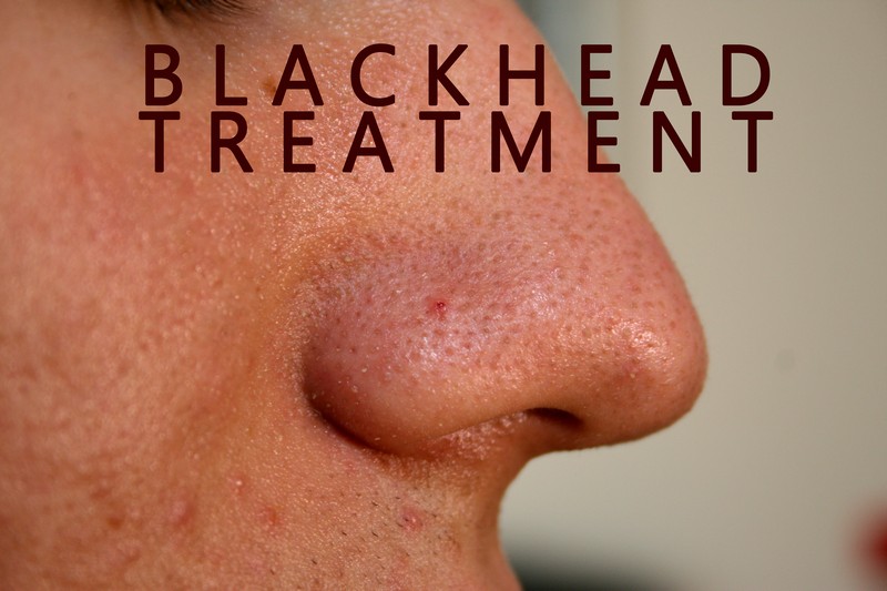 blackhead treatment