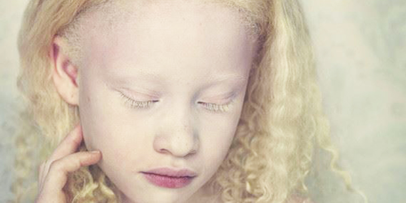girl suffering from albinism