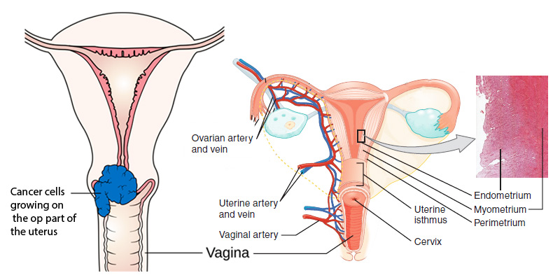 image showing parts of uterus and cancer cells