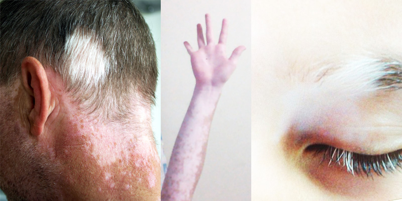 vitiligo effected people